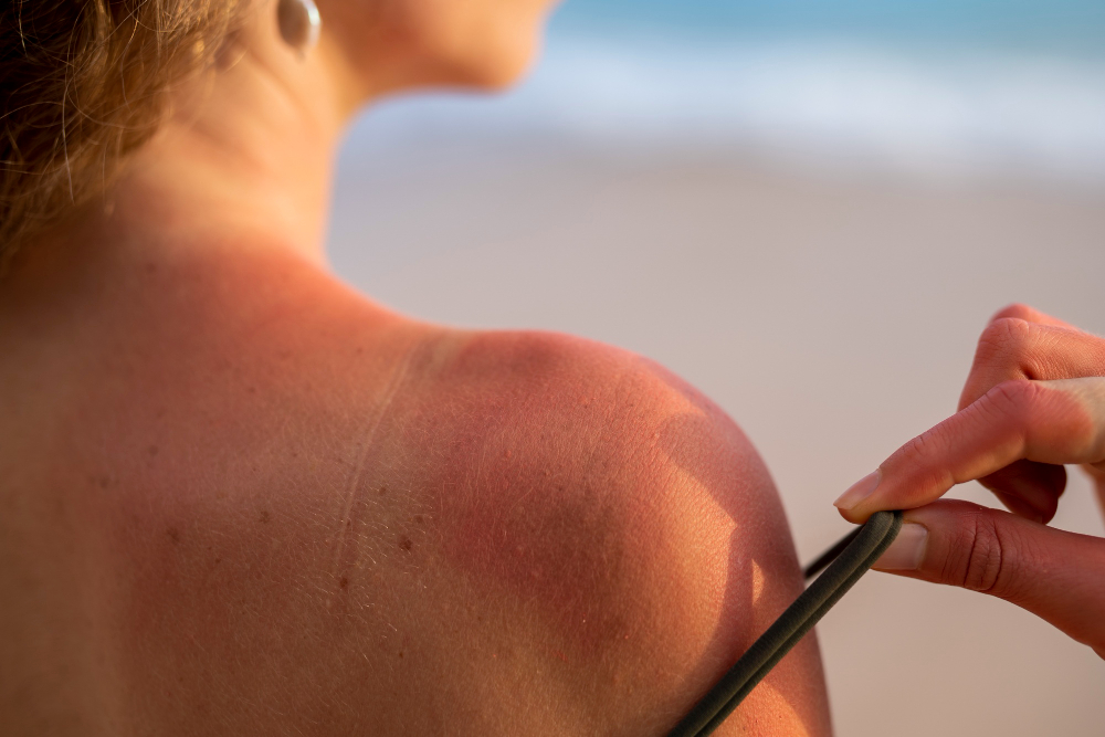 Quais são os benefícios de tomar sol? 5 queimadura de sol